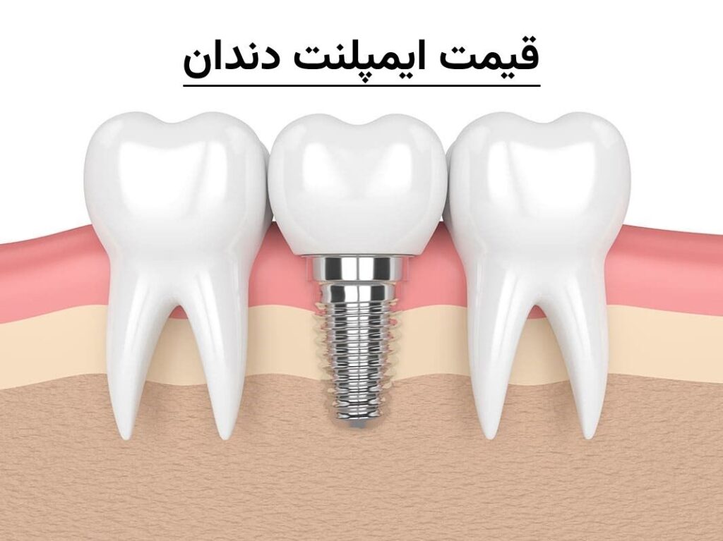 قیمت ایمپلنت دندان 1404 | هزینه انواع ایمپلنت در تهران
