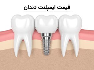 قیمت ایمپلنت دندان 1404 | هزینه انواع ایمپلنت در تهران