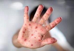 14 مورد بیماری سرخک در بابل مشاهده شد