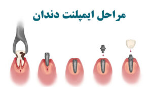 مراحل ایمپلنت دندان چیست (۶ مرحله ایمپلنت + فیلم وعکس)