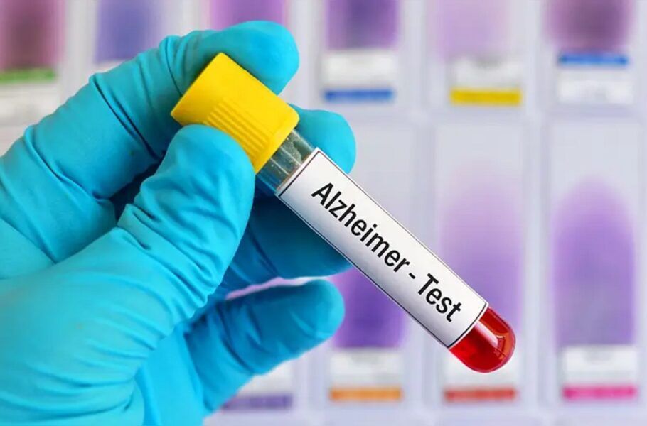 تولید رادیو داروی تشخیص آلزایمر در البرز
