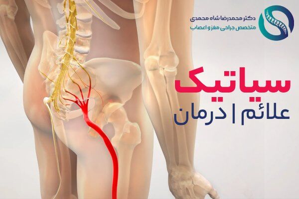سیاتیک چیست و چه علائمی دارد؟ بهترین درمان از نظر دکتر شاه محمدی متخصص دیسک کمر
