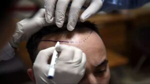 ترکیه به پایتخت کاشت موی جهان تبدیل شده است
