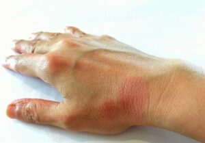 اخبار پزشکی | کشف جدید دانشمندان درباره علت بیماری "لوپوس"/ خروج تومور بدخیم از مغز کودک 10 ساله در بیداری