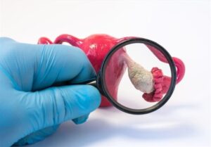 امیدی جدید برای زنان مبتلا به تخمدان پلی کیستیک/تغذیه ای که افسردگی را کاهش می دهد