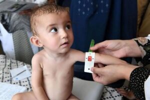 واریز دو مرحله یارانه رفع سوءتغذیه کودکان زیر ۵ سال